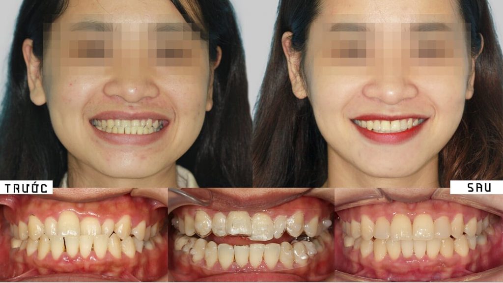 niềng răng có thay đổi hình dạng khuôn mặt không