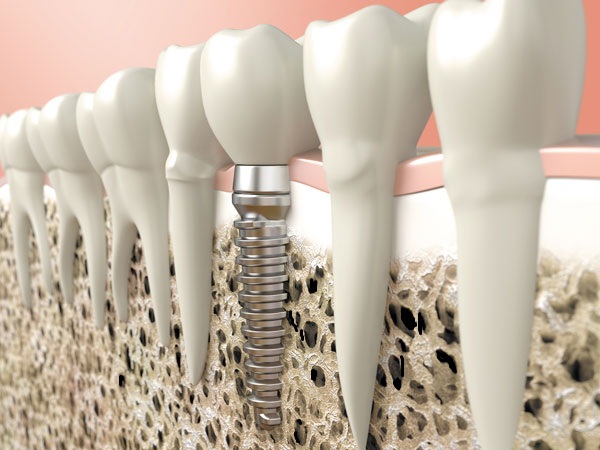 Cấy ghép Implant thay thế răng mất