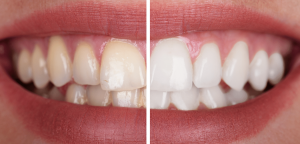 tại sao răng đau sau khi làm trắng