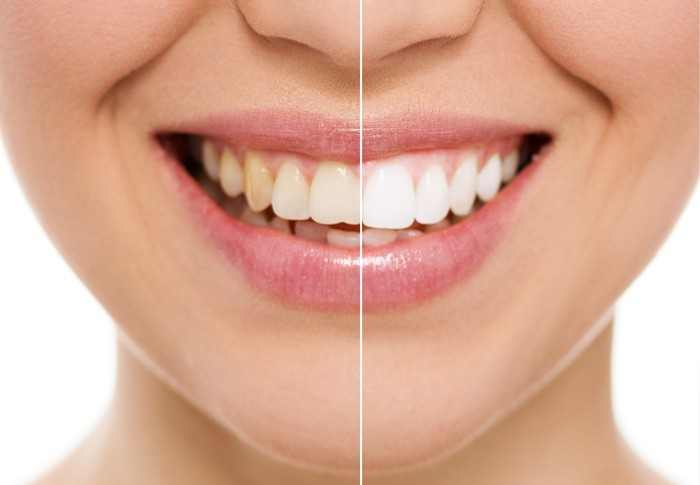Tại sao răng bị đau sau khi làm trắng