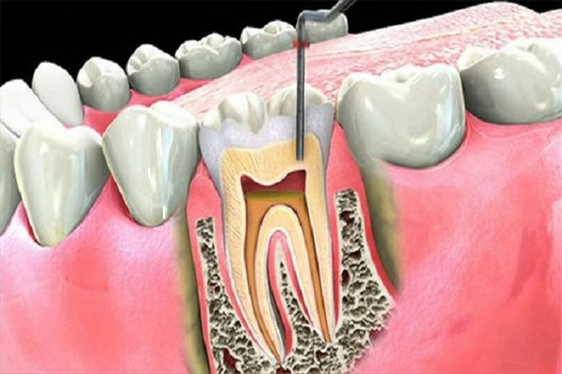 điều trị tủy răng