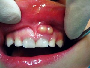 điều trị áp xe răng