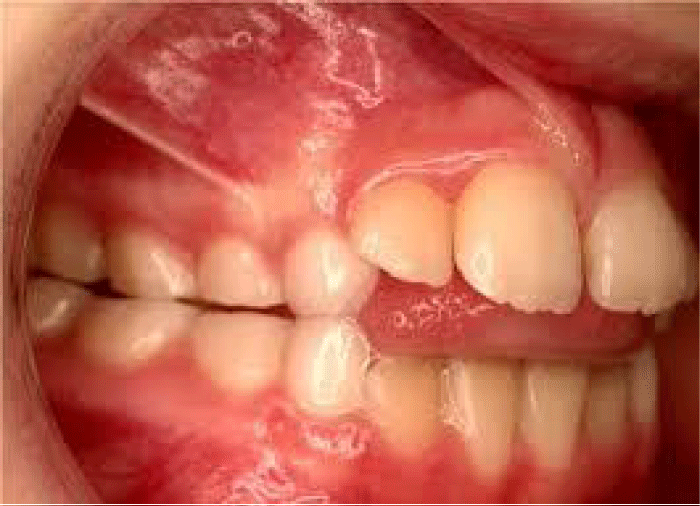 đẩy nhanh - Thói quen xấu gây nên tình trạng răng hô và khe thưa!