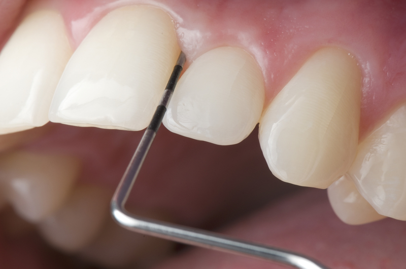 Mài kẽ răng là gì? Tại sao bác sĩ lại đề nghị phải mài răng để chỉnh nha? M%C3%A0i-k%E1%BA%BD