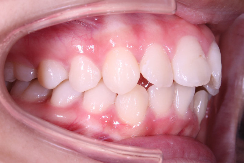 Nhận biết tình trạng răng hô 