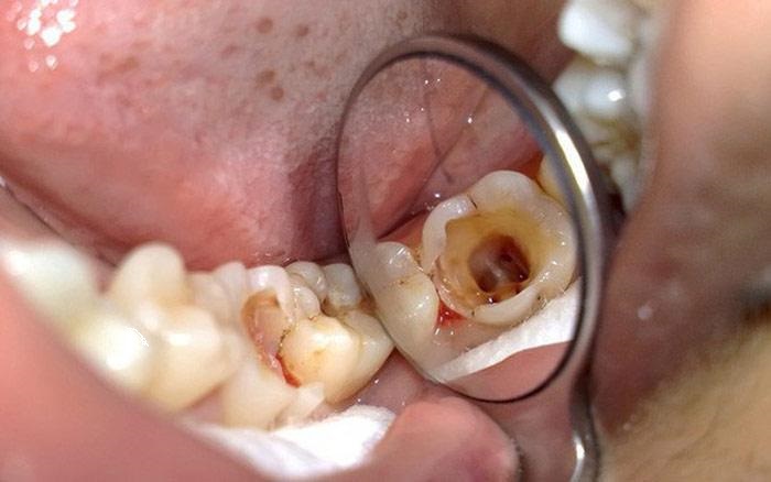 Top những vấn đề về răng miệng 