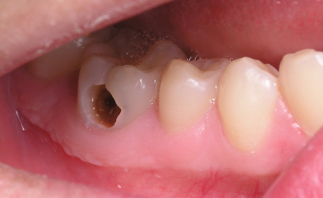Răng điều trị tủy
