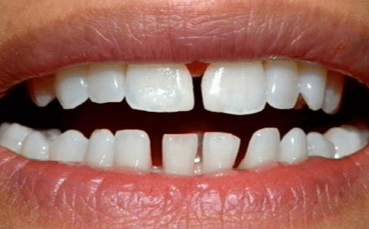 phương pháp niềng răng