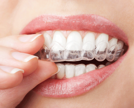 Tật nghiến răng 