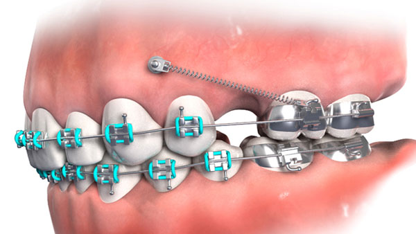 Cấy Minivis trong chỉnh nha