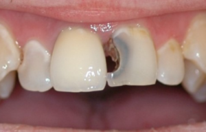 Tình trạng sâu răng