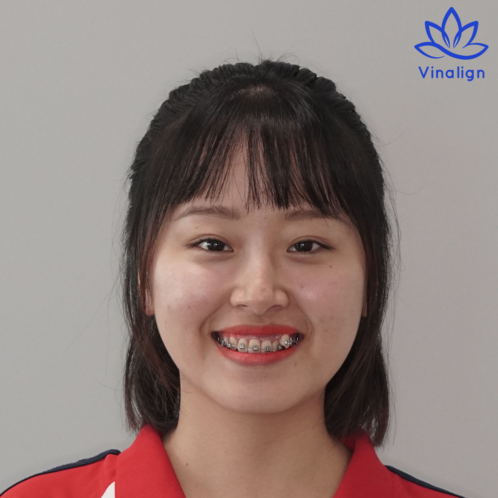 niềng răng vinalign