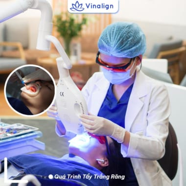 Quy trình tẩy trắng răng tại nha khoa Vinalign