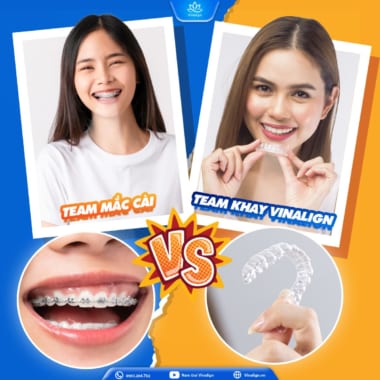 niềng răng là một trong những phương pháp điều trị viêm khớp thái dương hàm