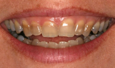 răng nhiễm Tetracycline