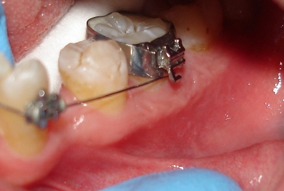 Thân răng ngắn là một trong những trường hợp được chỉ định đặt band
