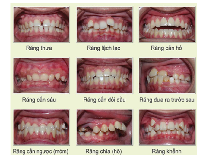 khớp cắn lệch lạc