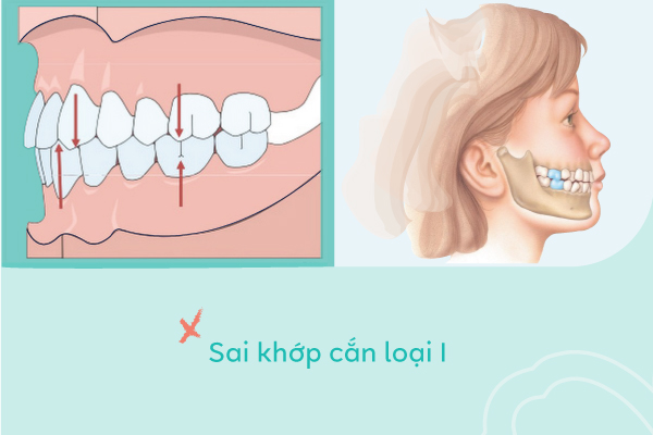 lệch lạc khớp cắn loại 1