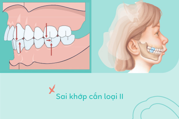 lệch lạc khớp cắn loại 2