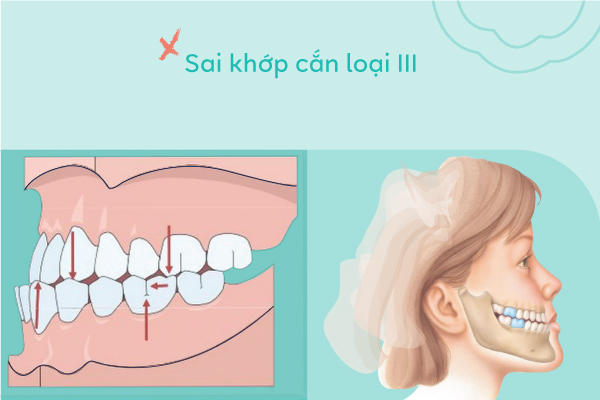 lệch lạc khớp cắn loại 3