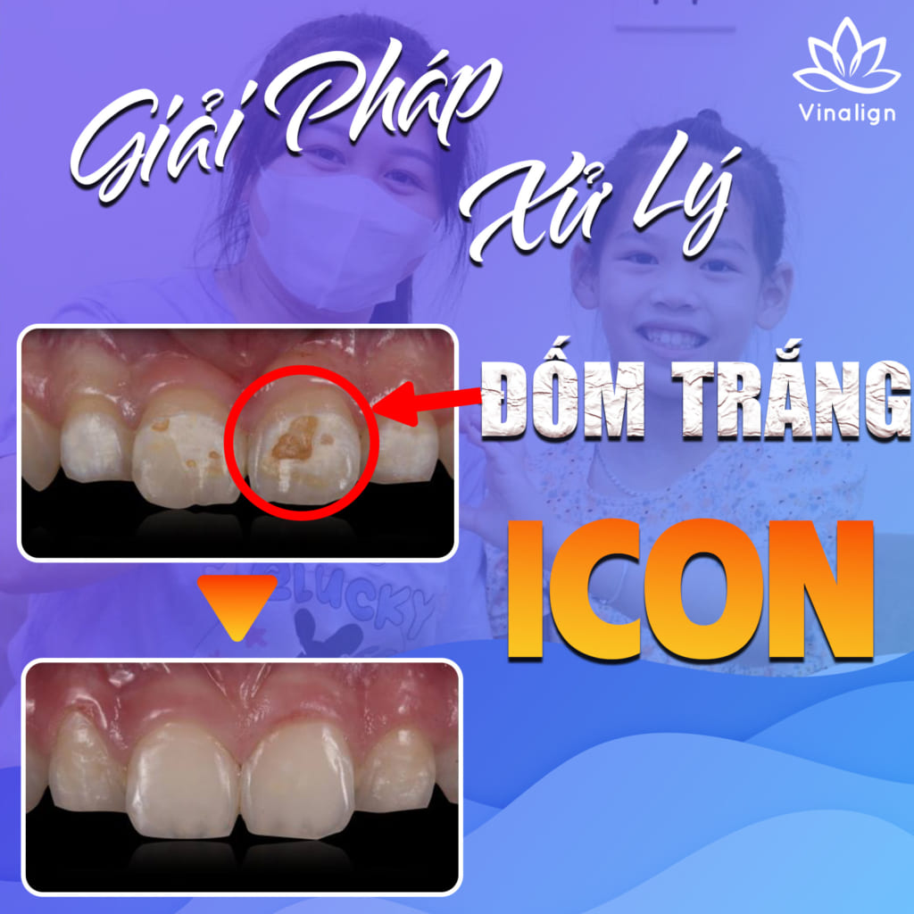 ICON - Giải pháp xử lý đốm trắng hiệu quả