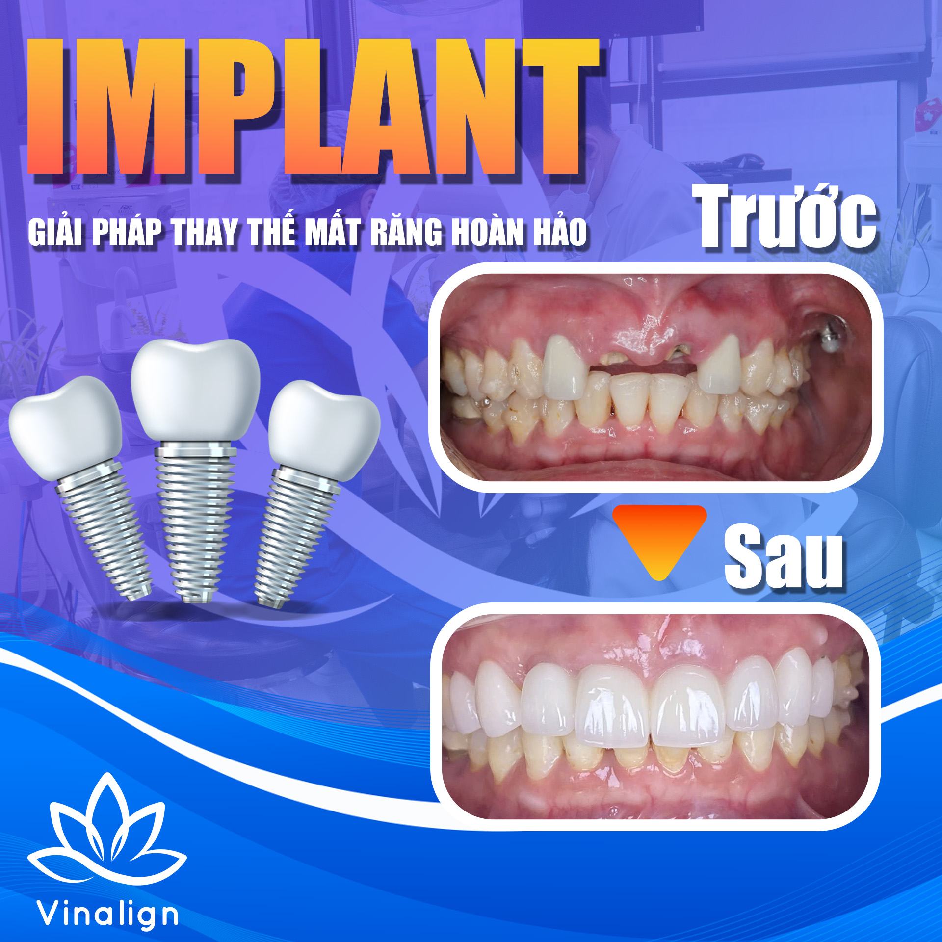 Phương pháp cấy implant phục hình thay thế cho răng mất 