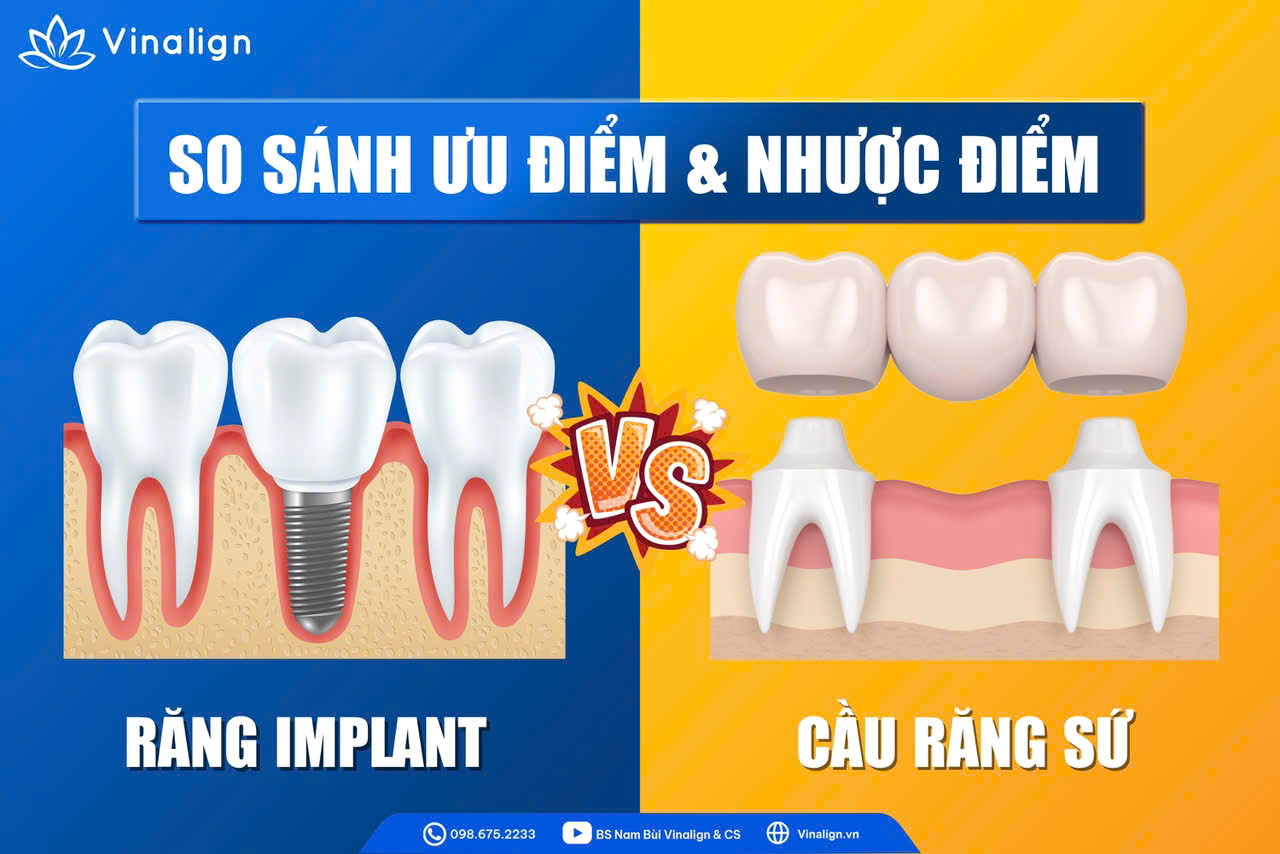 Ưu nhược điểm của làm cầu và cấy Implant