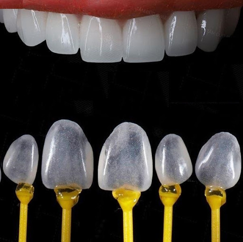 dán sứ veneer