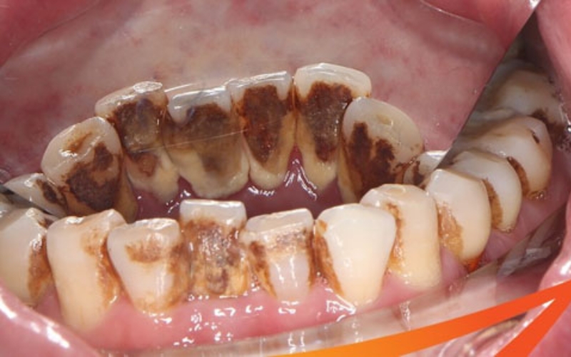 Mảng bám cao răng huyết thanh