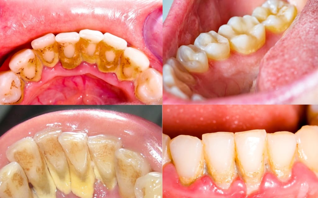 Mảng bám cao răng