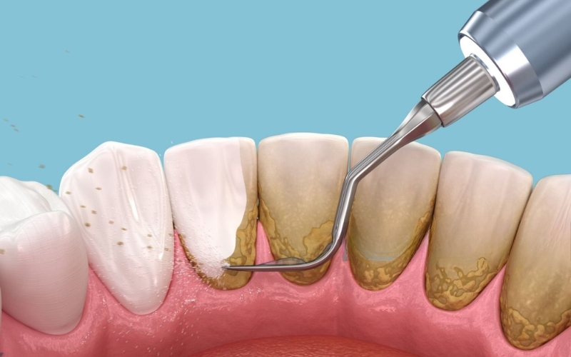 Lấy cao răng bằng sóng siêu âm