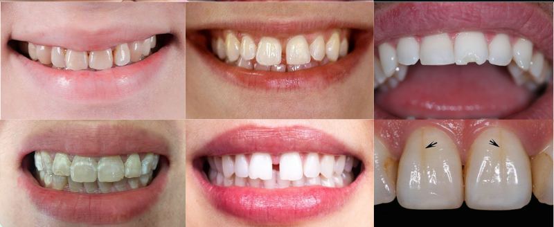 Các trường hợp nên dán sứ Veneer