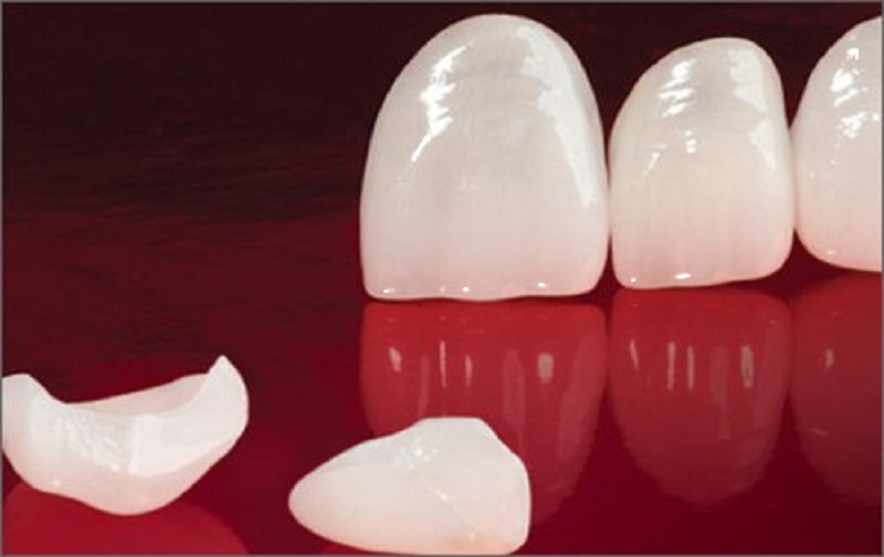 Dán sứ Veneer