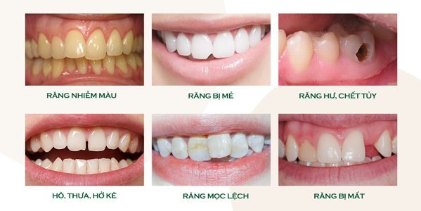 Các trường hợp nên bọc răng sứ