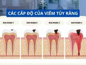 Các cấp độ của viêm tủy răng