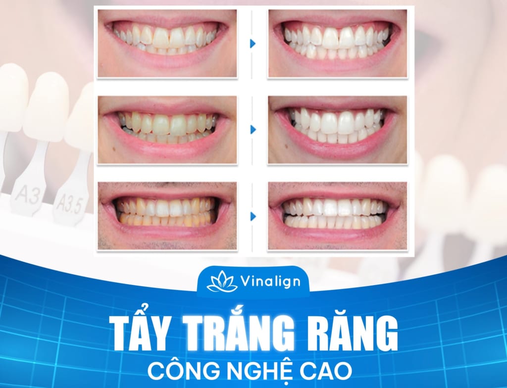Tẩy trắng răng công nghệ cao