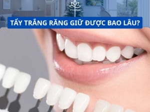 Tẩy trắng răng giữ được bao lâu