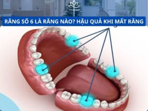 răng số 6 trên cung hàm