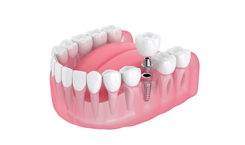 Trồng răng Implant khi mất răng số 6